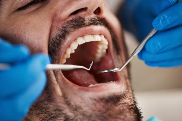 Best Emergency Dental Extractions in Charlestown, IN