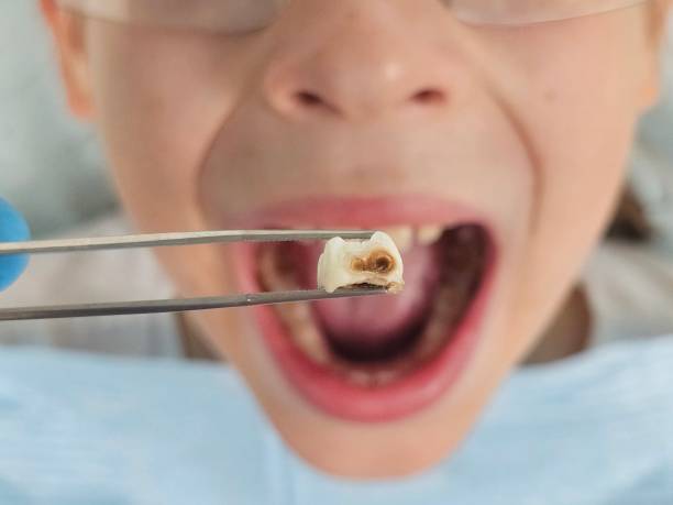 Best Emergency Dentist for Knocked-Out Tooth in Charlestown, IN