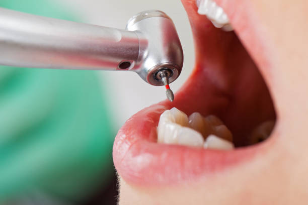 Best Emergency Root Canal Treatment in Charlestown, IN